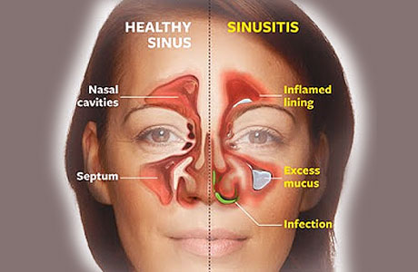 persistent nasal congestion